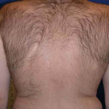Before and After Laser Hair Removal on the Back