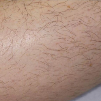 Before and After Laser Hair Removal on the Arm