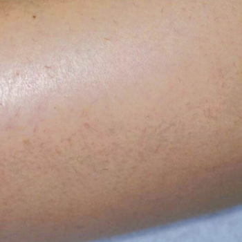 Before and After Laser Hair Removal on the Arm