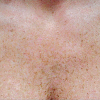 Before and After Pictures of Chest Crea with AFT Photorejuvenation Treatment.