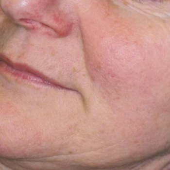 Before and After Pictures of Laugh Lines with AFT Photorejuvenation Treatment.