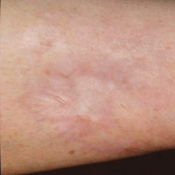 Before and After Pictures of Arm Scar with AFT Photorejuvenation Treatment.