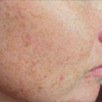 Before and after Pictures of the Right Cheek Smoothness with AFT Photorejuvenation Treatment.