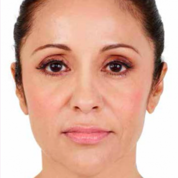 Before and After Pictures with Juvederm Family of Fillers for Facial Lines.