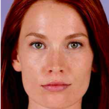 Before and After Pictures with Juvederm Family of Fillers on Female