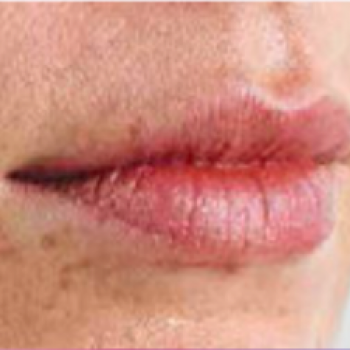 Before and After Pictures with Juvederm Family of Fillers on Lips Area