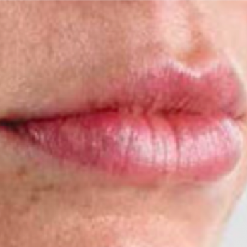 Before and After Pictures with Juvederm Family of Fillers on Lips Area