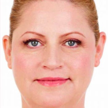 Before and After Pictures with Juvederm Family of Fillers for Laugh Lines