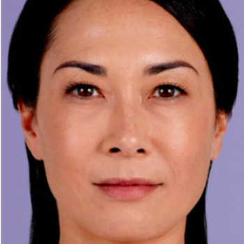 Before and After with Juvederm Family of Fillers for Frown LinesPictures
