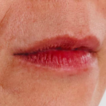 Before and After Pictures with Juvederm Family of Fillers for Lip Wrinkles