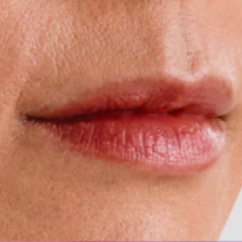 Before and After Pictures with Juvederm Family of Fillers for Lip Wrinkles