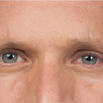 Before and After Pictures of Frown Lines with Botox Cosmetic Treatment on a Male.