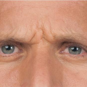 Before and After Pictures of Frown Lines with Botox Cosmetic Treatment on a Male.