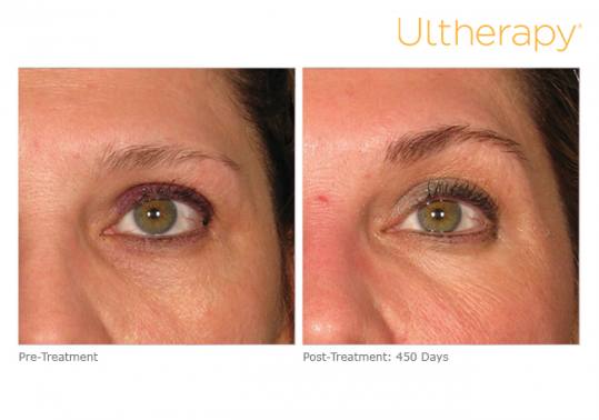 Before and After Pictures of Ultherapy in Eyebrow