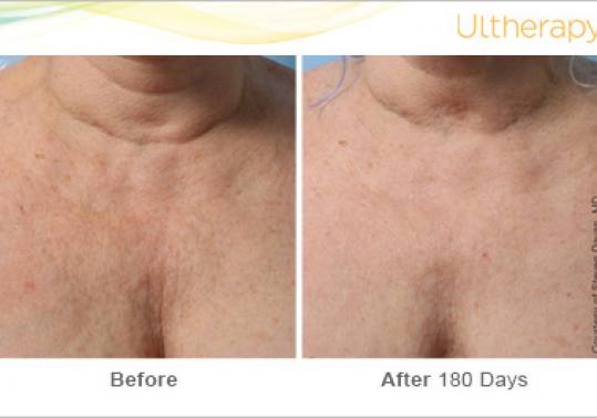 Before and After Pictures of Ultherapy in Chest