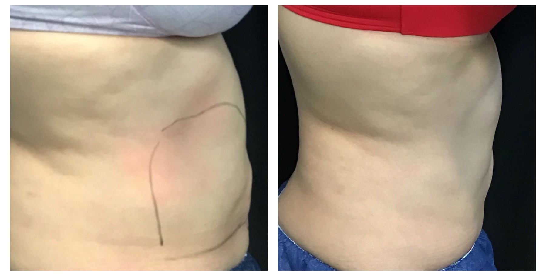 Before and After Pictures of CoolSculpting on Stomach