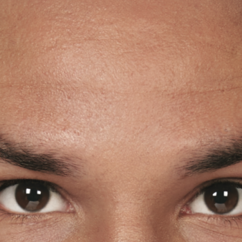 Before and After Pictures of Forehead Lines with Botox Cosmetic Treatment on a Male.