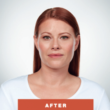 Before and After Pictures of Kybella Treament Front Side.