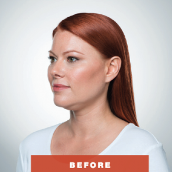 Before and After Pictures of Kybella Treatment Angle Side.