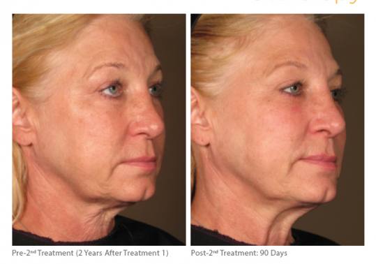 Before and After Pictures of Ultherapy. Female Side.
