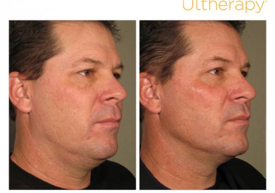 Before and After Pictures of Ultherapy. Male Side.