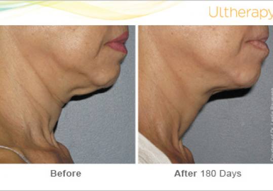 Before and After Pictures of Ultherapy in Neck