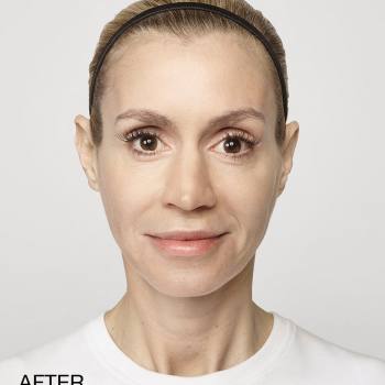Before and After Pictures of Restylane-L And Lyft Treatment.