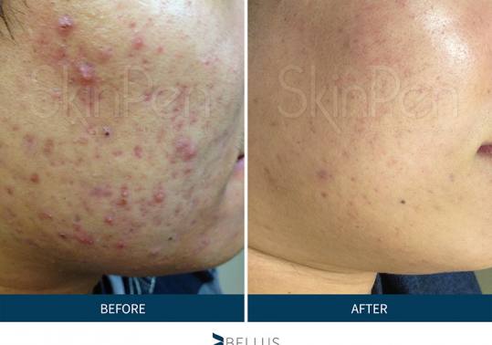 SkinPen acne scar reduction