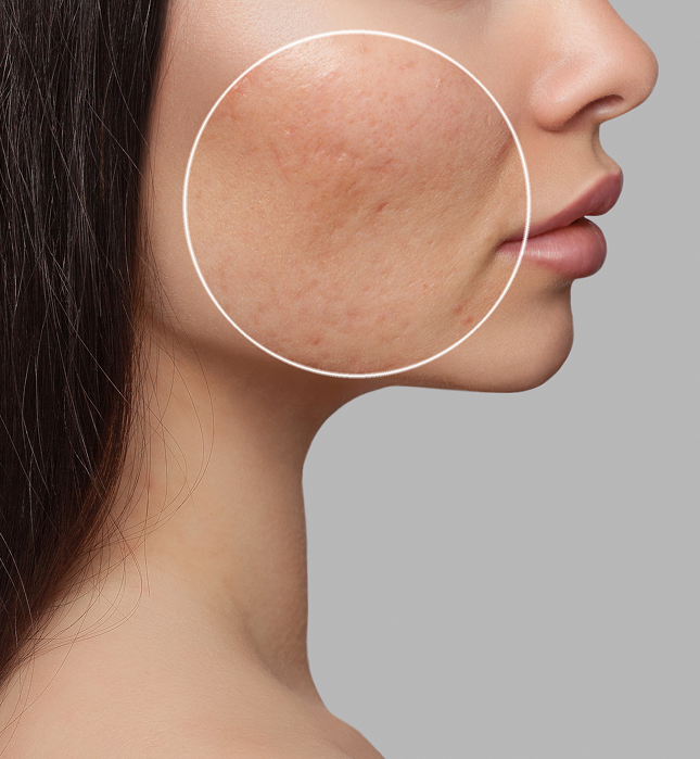 EXPERT CARE FOR ACNE