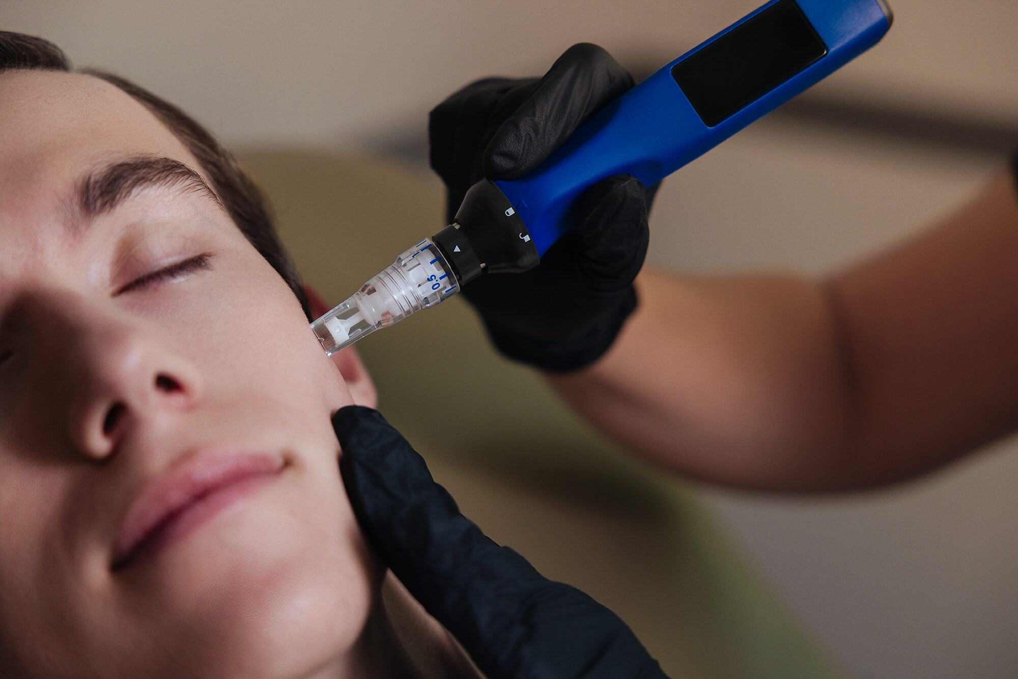 WHAT IS MICRONEEDLING?