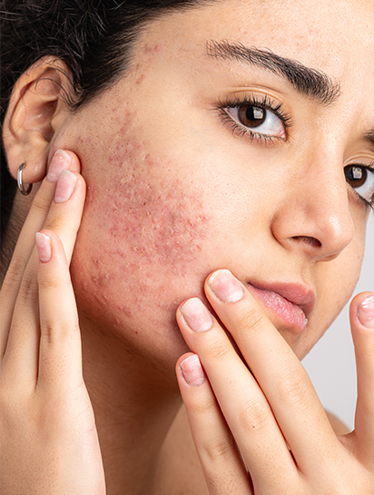 How Hormones Affect Your Skin: A Deep Dive Into Hormonal Acne Thumbnail