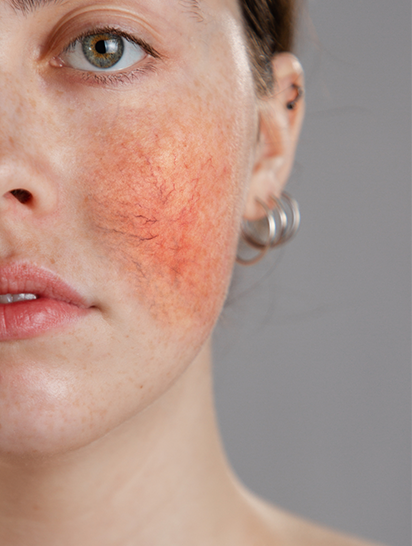 Rosacea 101