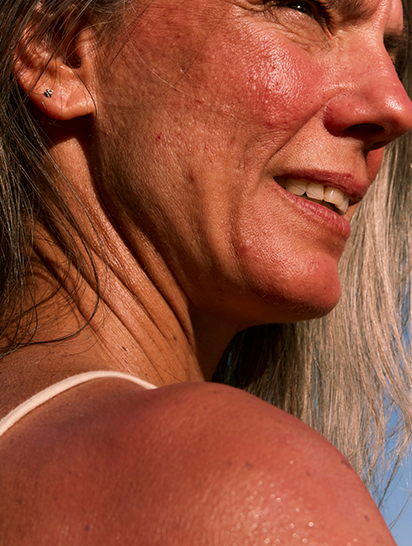 Signs of Sun Damage