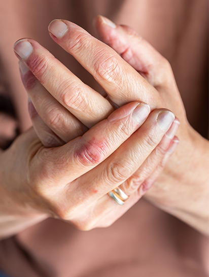 Spotlight on Springtime Skin Conditions: Eczema, Psoriasis, and Allergies